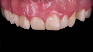 top jaw teeth with excessive tooth decay