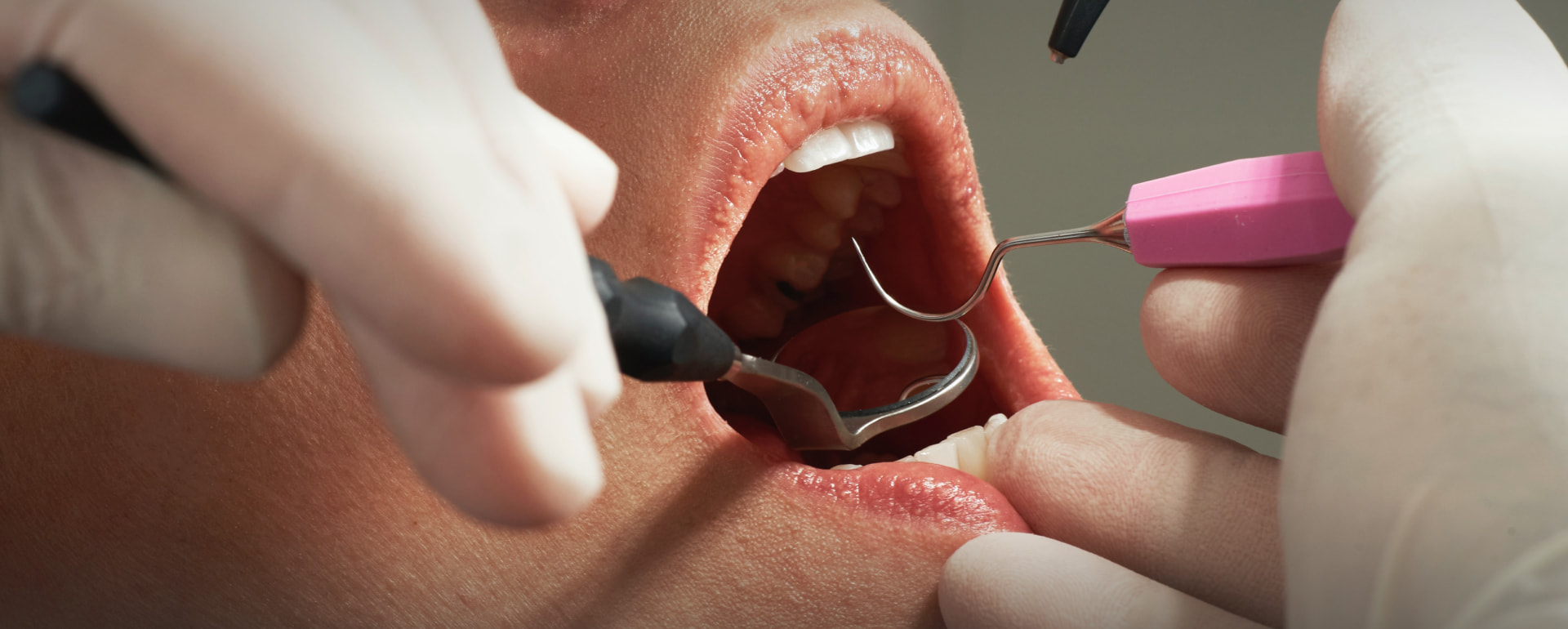 teeth and gums being examined by a dentist